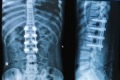 Spinal implants on X ray